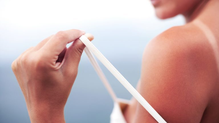 Алергия към слънцето – какво трябва да знаем