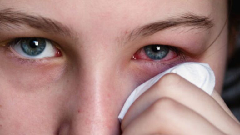 Домашни методи и рецепти при възпаления на очите
