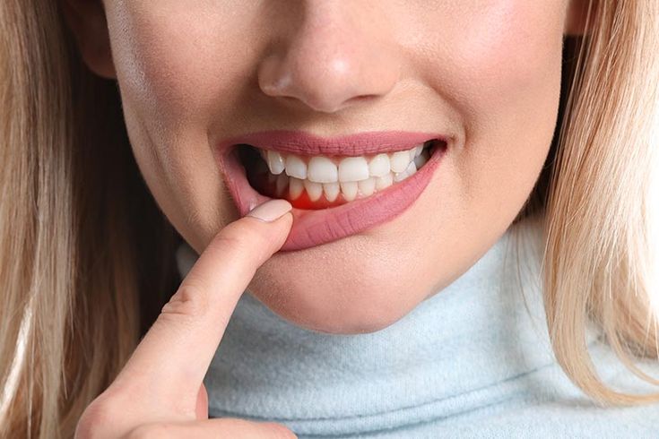 5 начина да спрете кървенето на венците