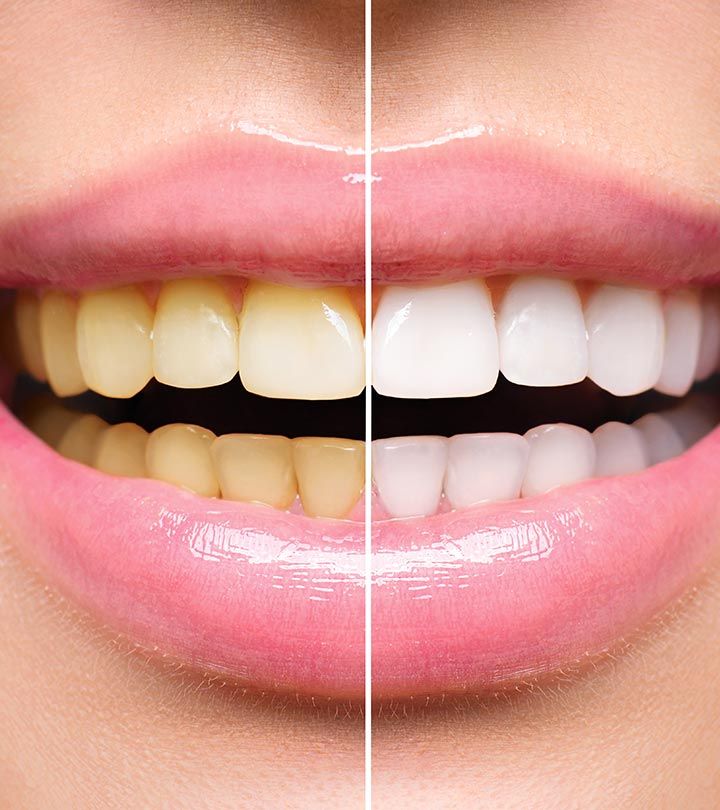 Оцветяването на зъбите е част от естественият процес на стареене
