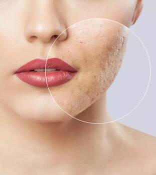  белези от акне 