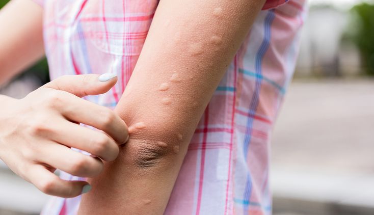 12 начина да намалите сърбежа при ухапване от комар