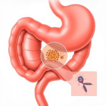 Живот с язва: как да намалим болката и да се чувстваме по-добре Живот с язва: как да намалим болката и да се чувстваме по-добре